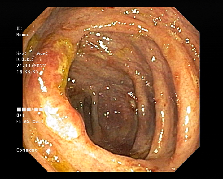 Colonoscopy images