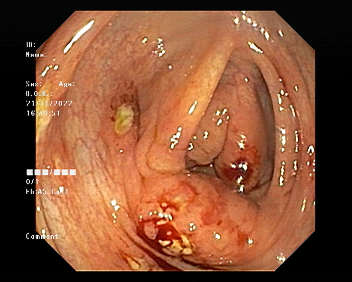 Colonoscopy images