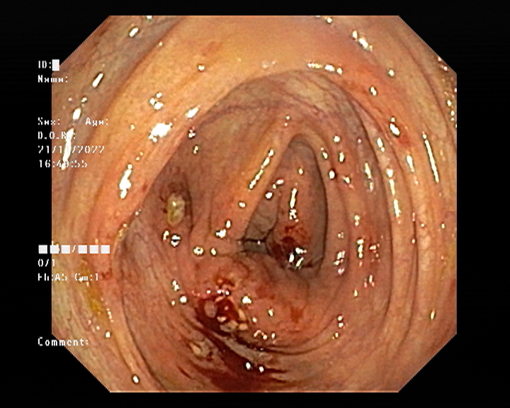 Colonoscopy images
