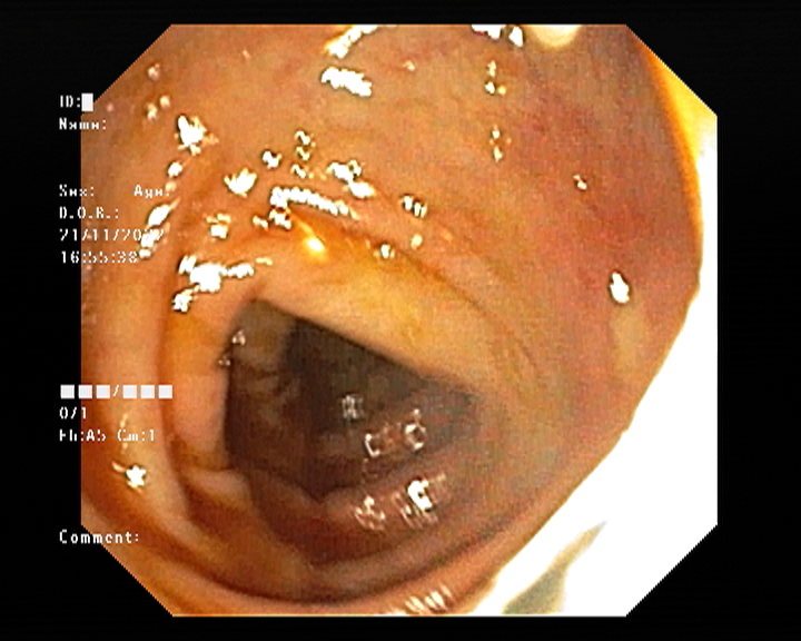 Colonoscopy images