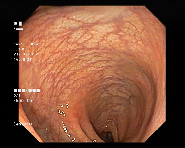 Colonoscopy images
