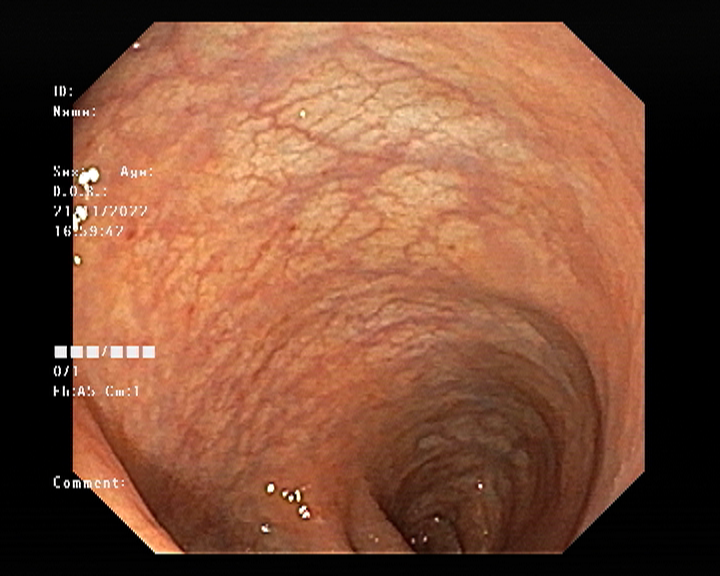Colonoscopy images